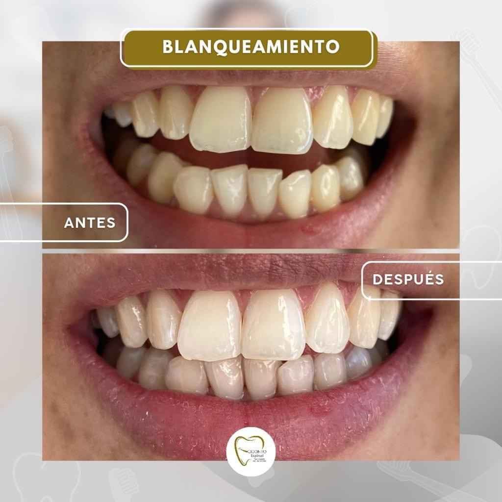 blanqueamiento_11zon